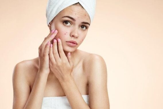 How to Know What Causes Your Acne Year-Round