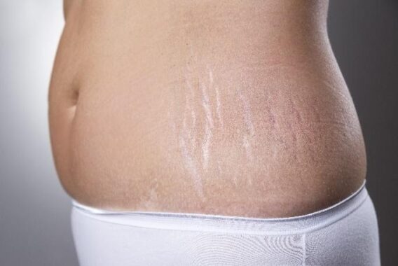 Tips for Getting Rid of Stretch Marks