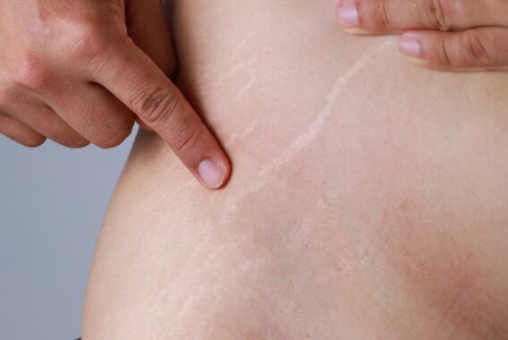 Blurring Stretch Marks with Lasers