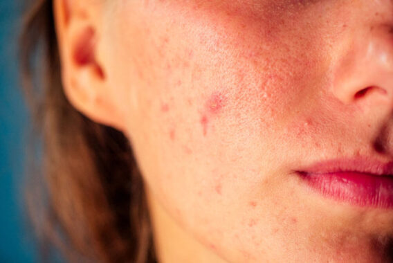 You Can Treat Acne Without Scarring: Here’s How