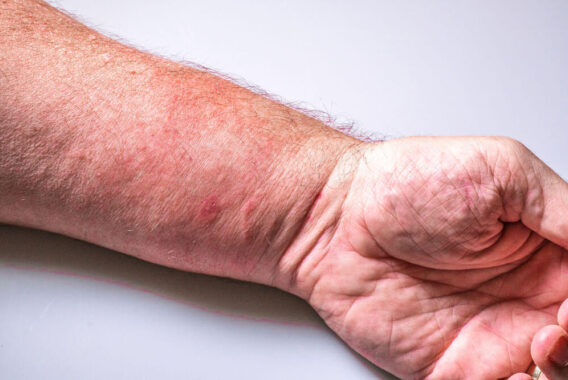 Stop the Itch! Find Relief From Poison Oak and Poison Ivy
