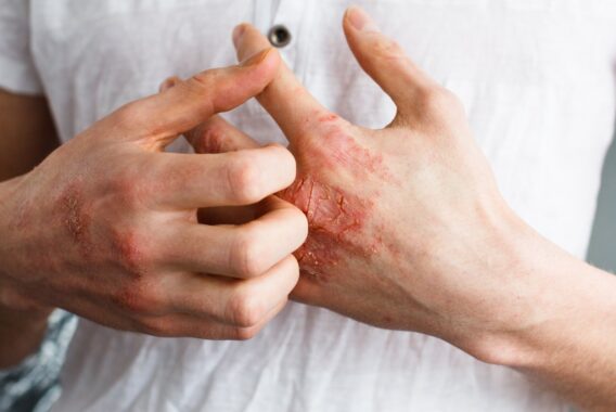 Keep Your Dermatitis/Eczema Under Control This Winter