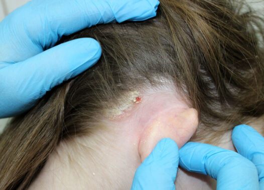 Lesions on the Scalp: Your Dermatologist May Suggest Mohs Surgery
