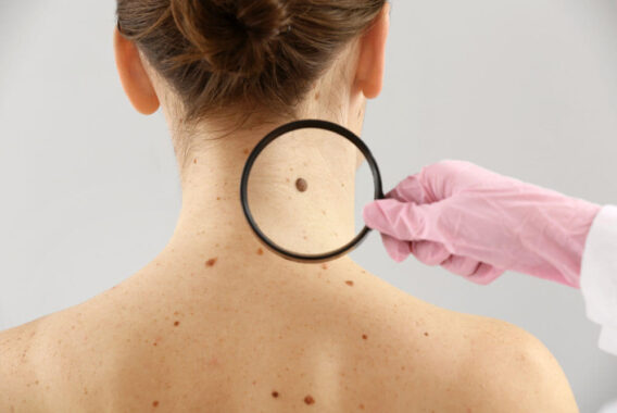 Why Do I Need to Get Moles Removed? Warning Signs of Skin Cancer