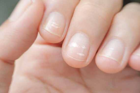 Can You Treat These 5 Common Nail Abnormalities at Home?