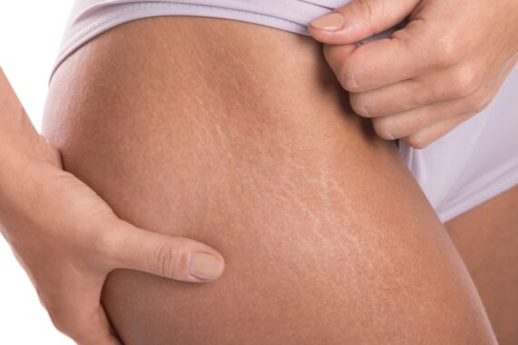 How to Be Proactive About Stretch Marks
