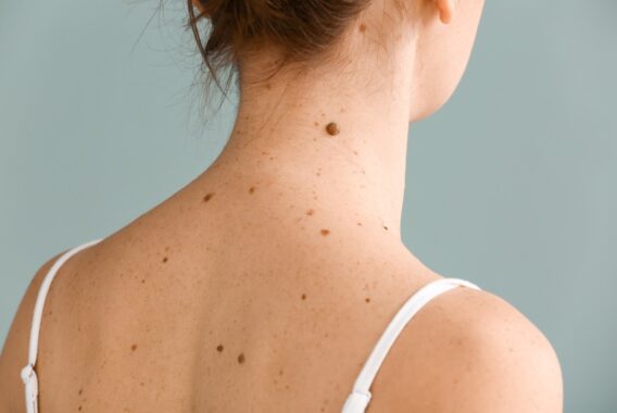How to Reduce Your Risk of Actinic Keratosis and Skin Cancer