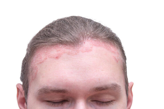 Do Over-the-Counter Shampoos Effectively Treat Scalp Psoriasis?