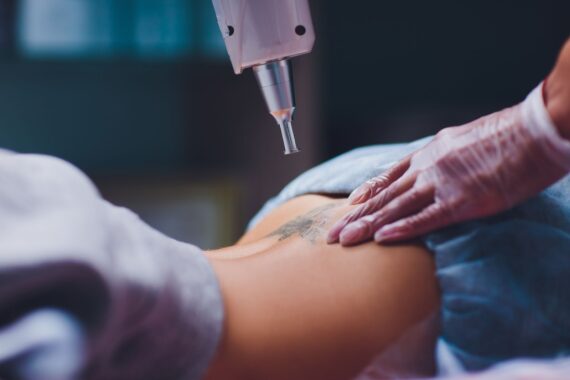 Why Spring Is the Perfect Time to Start Your Tattoo Removal Journey