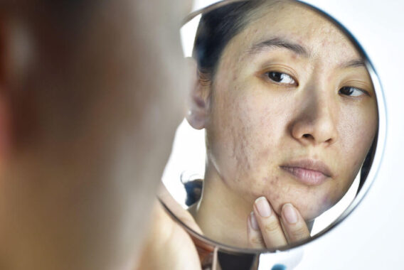 Acne Scarring: Finding the Best Remedies