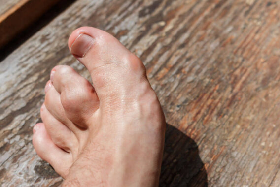 Psoriatic Arthritis: Understanding the Underlying Causes