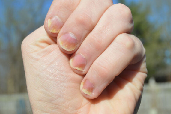 Understanding Nail Health and Common Nail Problems
