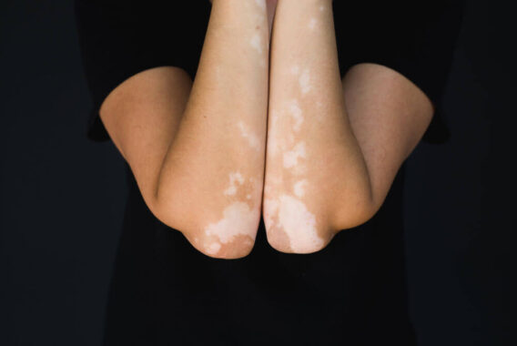 What Everyone Should Know About Vitiligo
