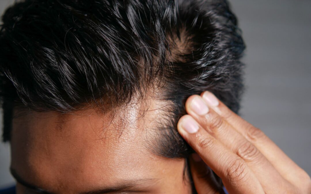 August is Hair Loss Awareness Month