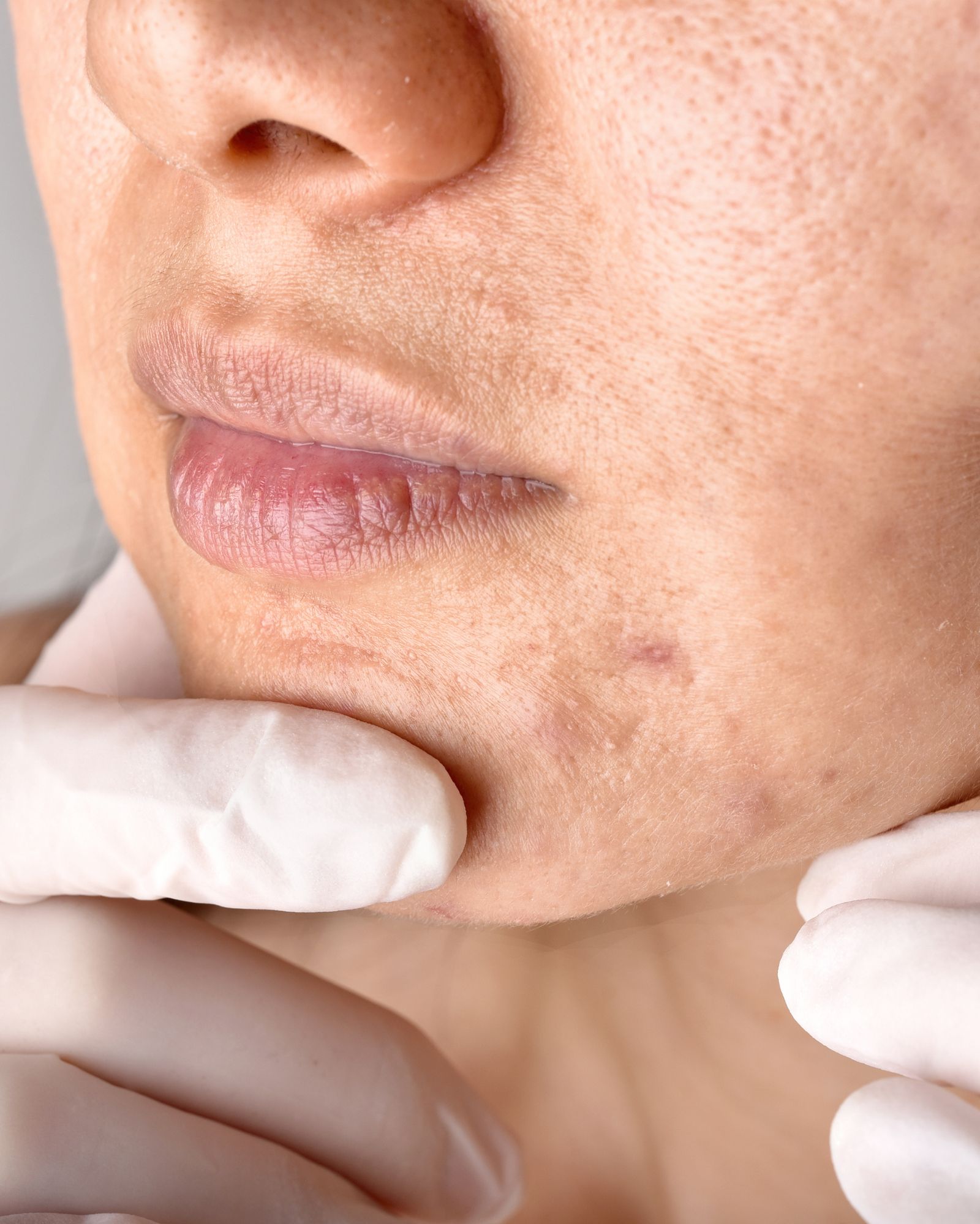Brown Spots After Summer? Causes & Treatment Options